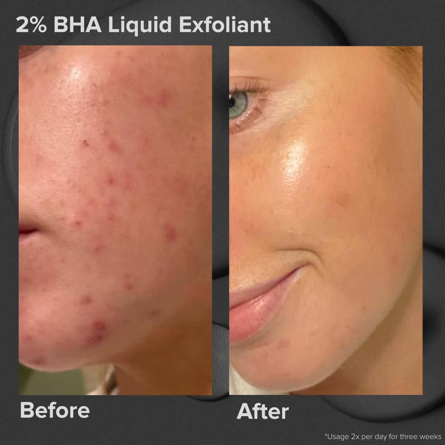 Paula's Choice Skin Perfecting 2% BHA Liquid Exfoliant 30ml
